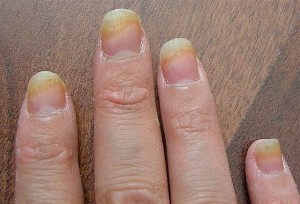 Грибок на пальцах рук: от диагностики до лечения
